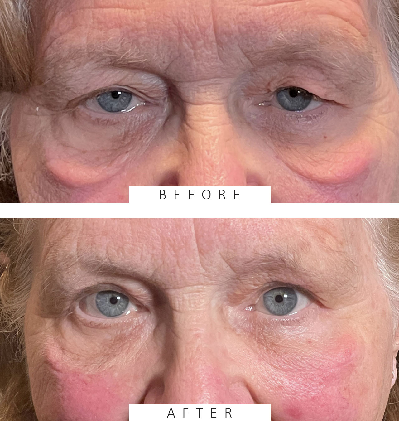 Cosmetic Upper & Lower Blepharoplasty