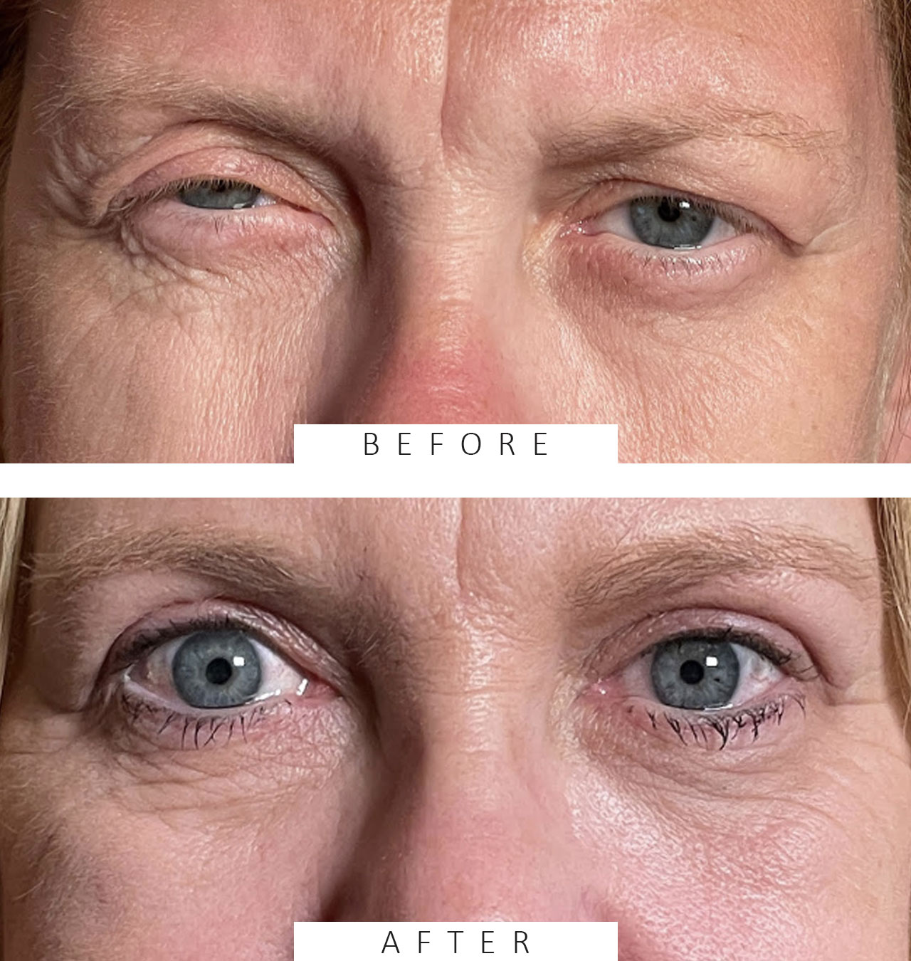 Cosmetic Blepharoplasty