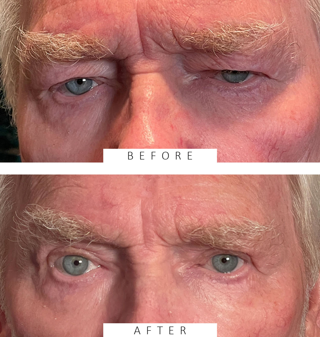 Cosmetic Blepharoplasty Both Upper Lids