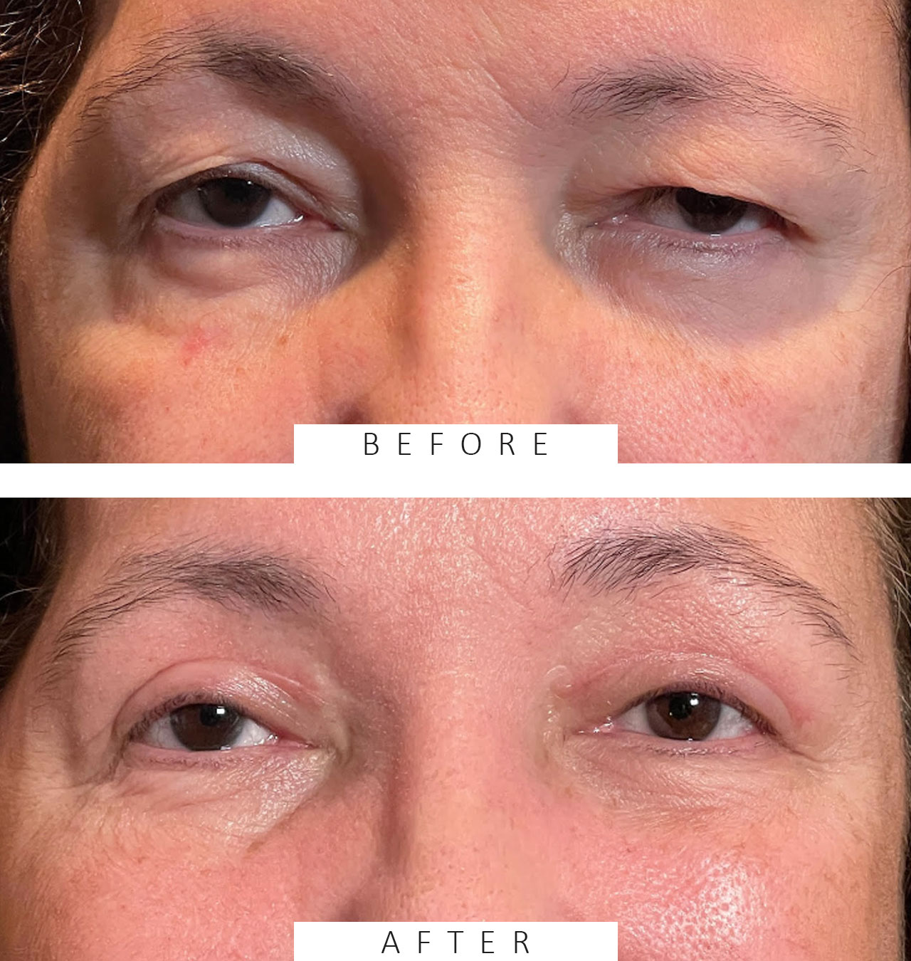 Ptosis Repair Both Upper Lids Cosmetic Blepharoplasty Both Upper lids