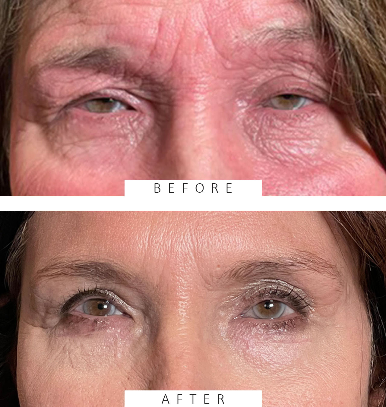 Cosmetic Blepharoplasty Both Upper and Lower Lids & Ptosis Repair.