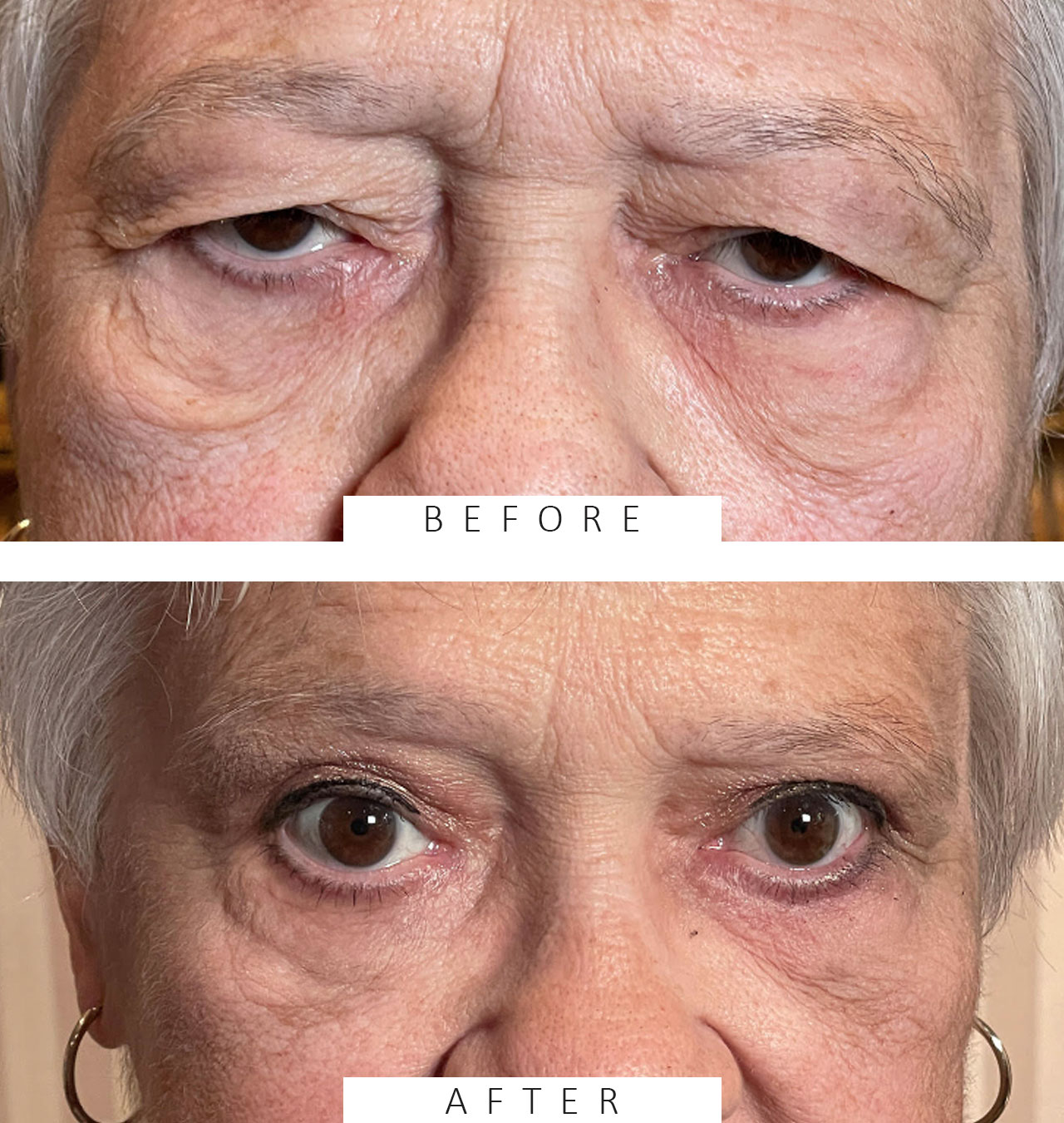 Upper and Lower Lid Cosmetic Blepharoplasty