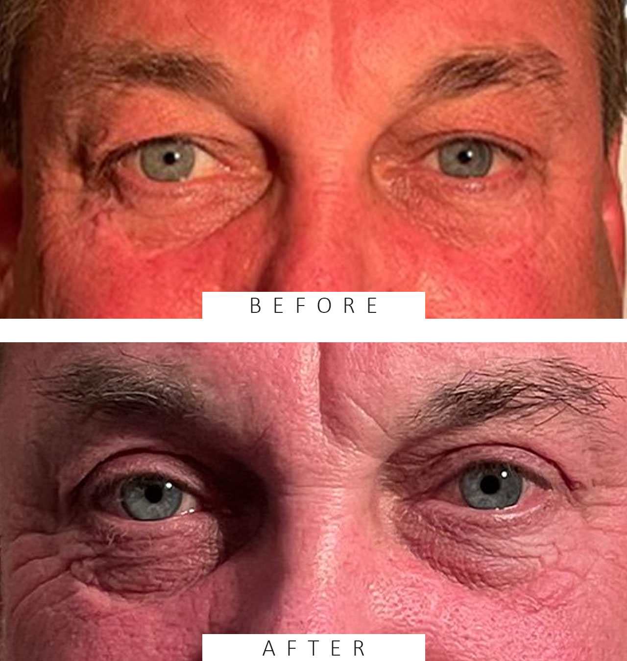 Blepharoplasty
