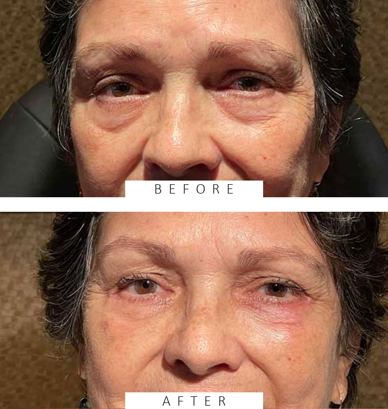 Lower Lid Blepharoplasty with Fat Transposition to Treat Infraorbital Hollows
