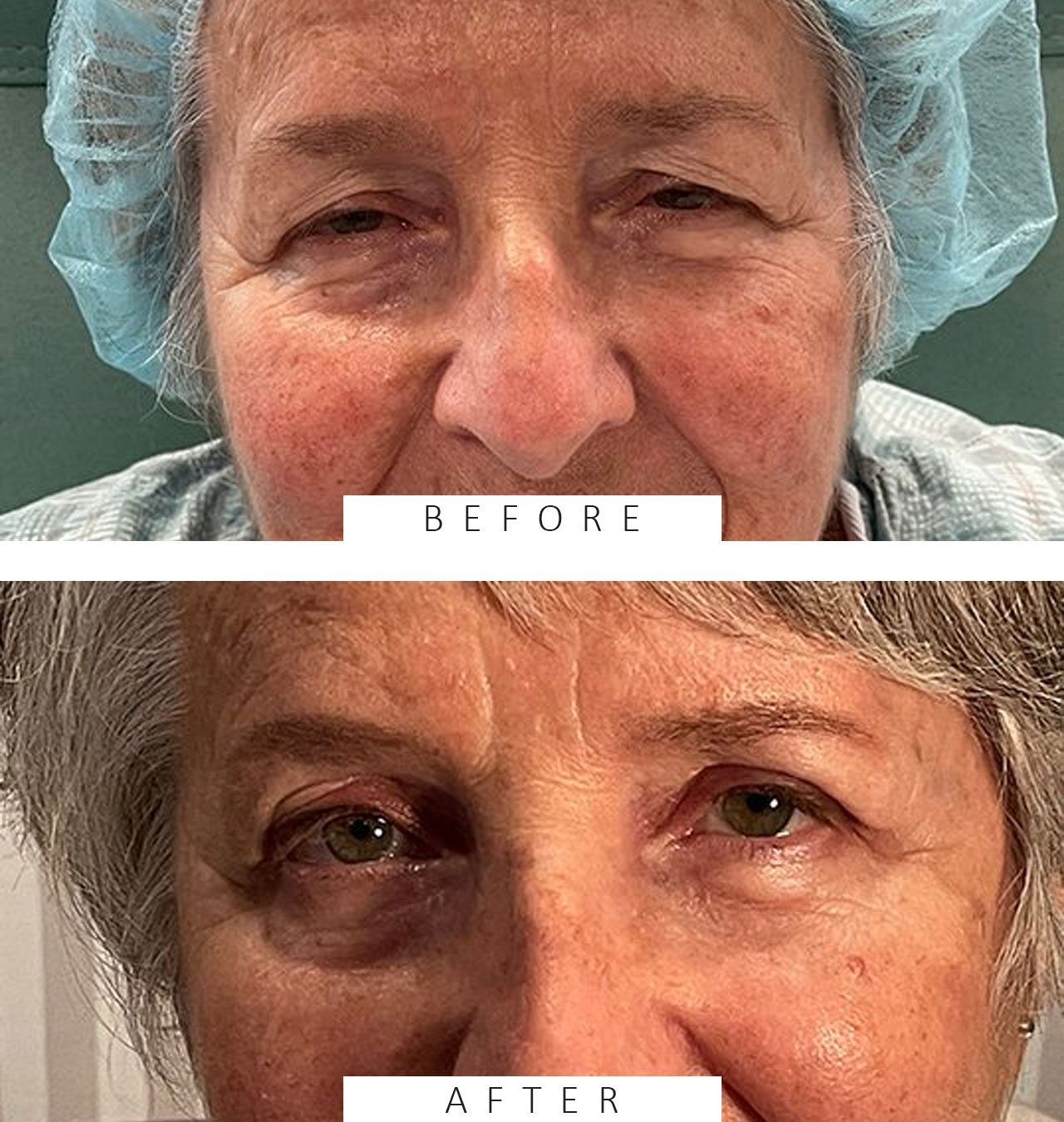 Blepharoplasty to revitalize both eyes