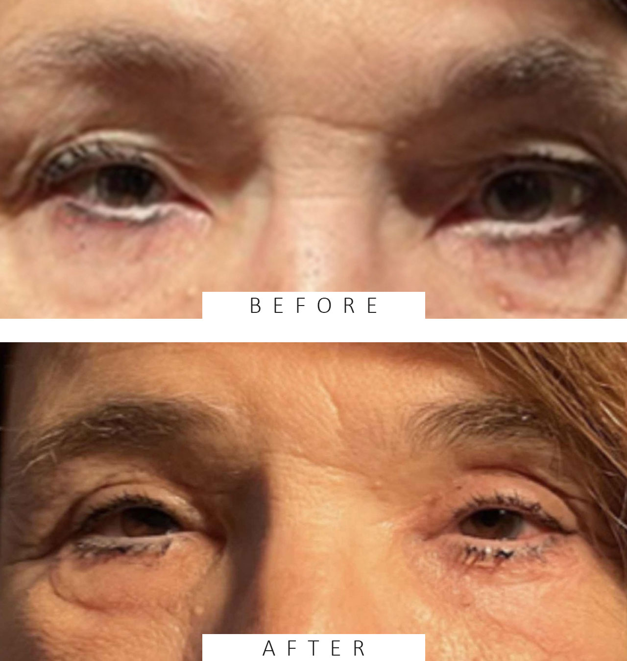 Upper & Lower Blepharoplasty