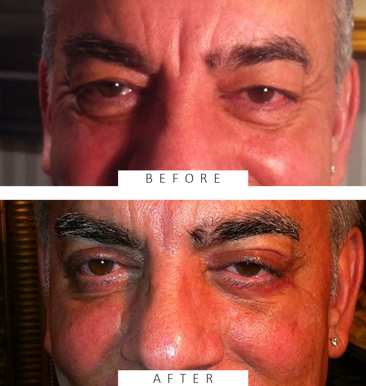 Upper & Lower Blepharoplasty