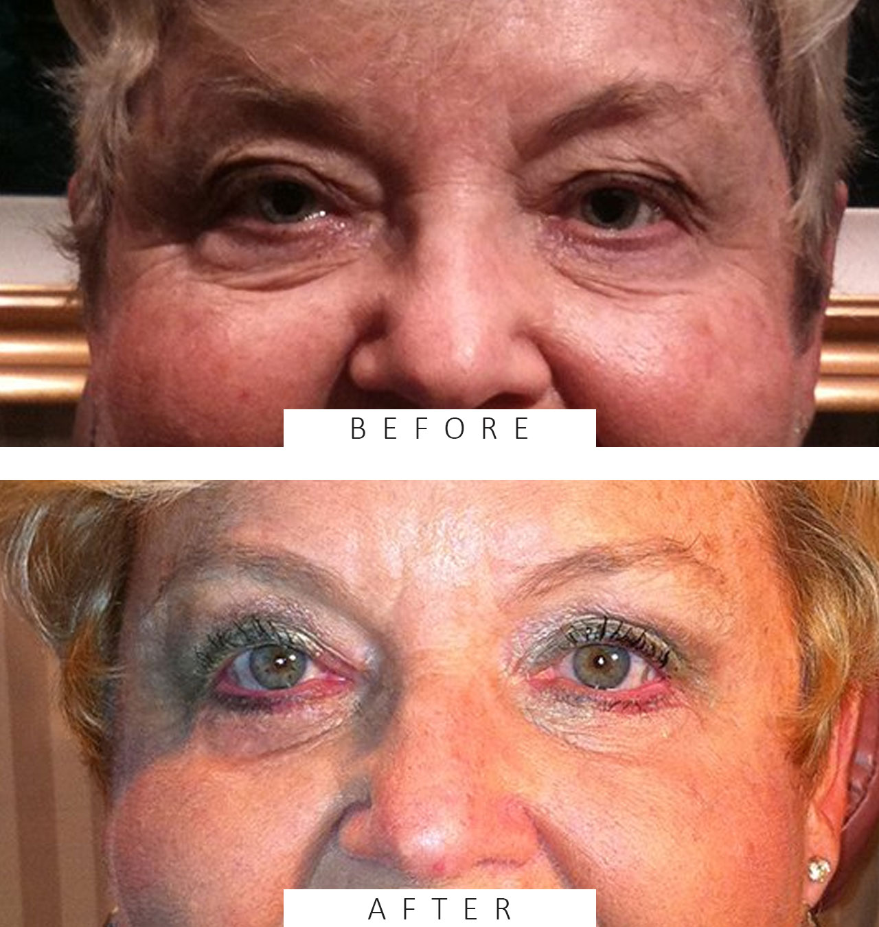 Upper & Lower Blepharoplasty