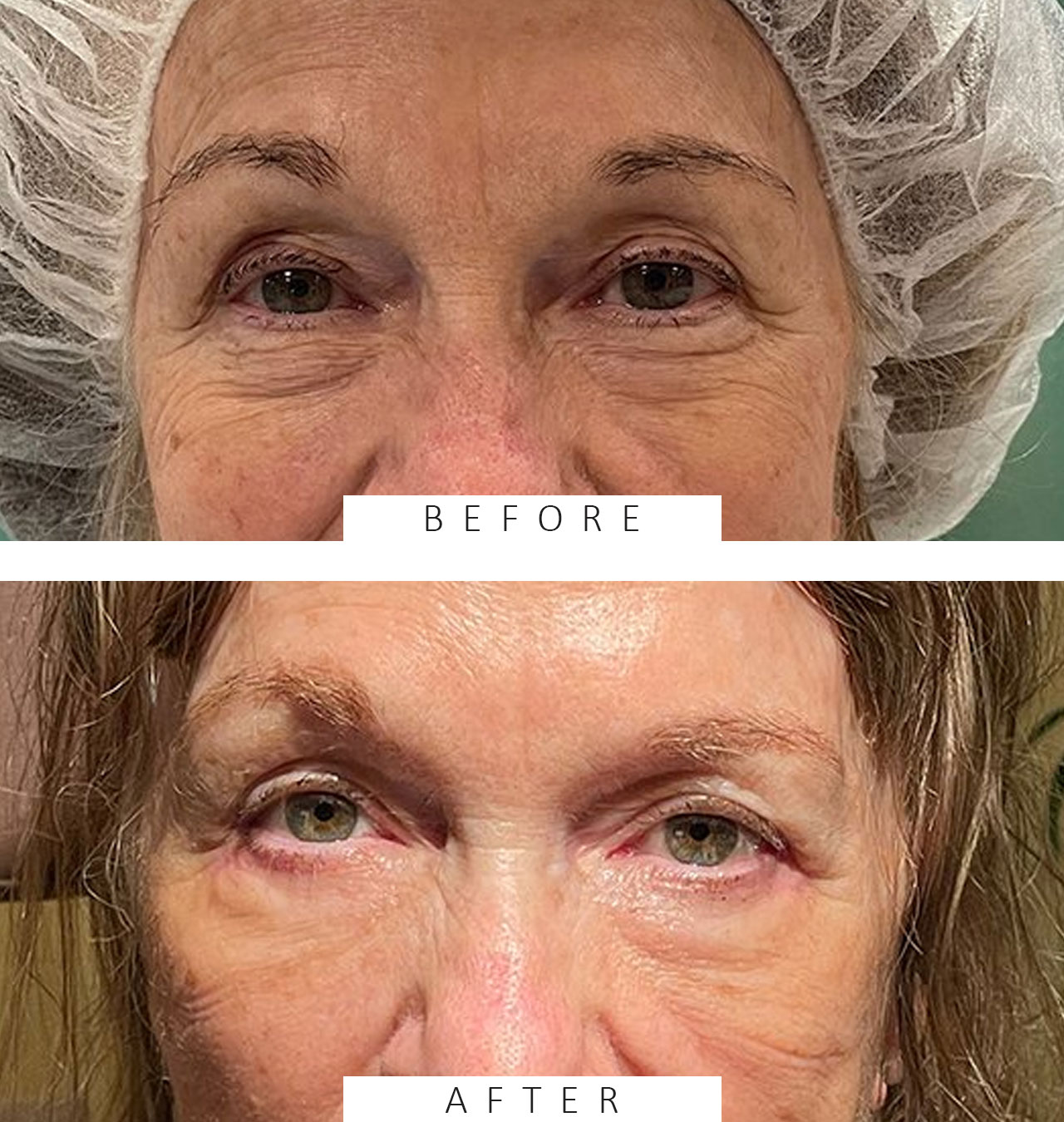 Lower Lid Blepharoplasty