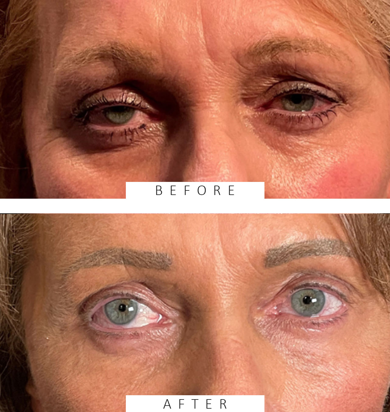 Ptosis Repair Upper Lids MMCR Procedure