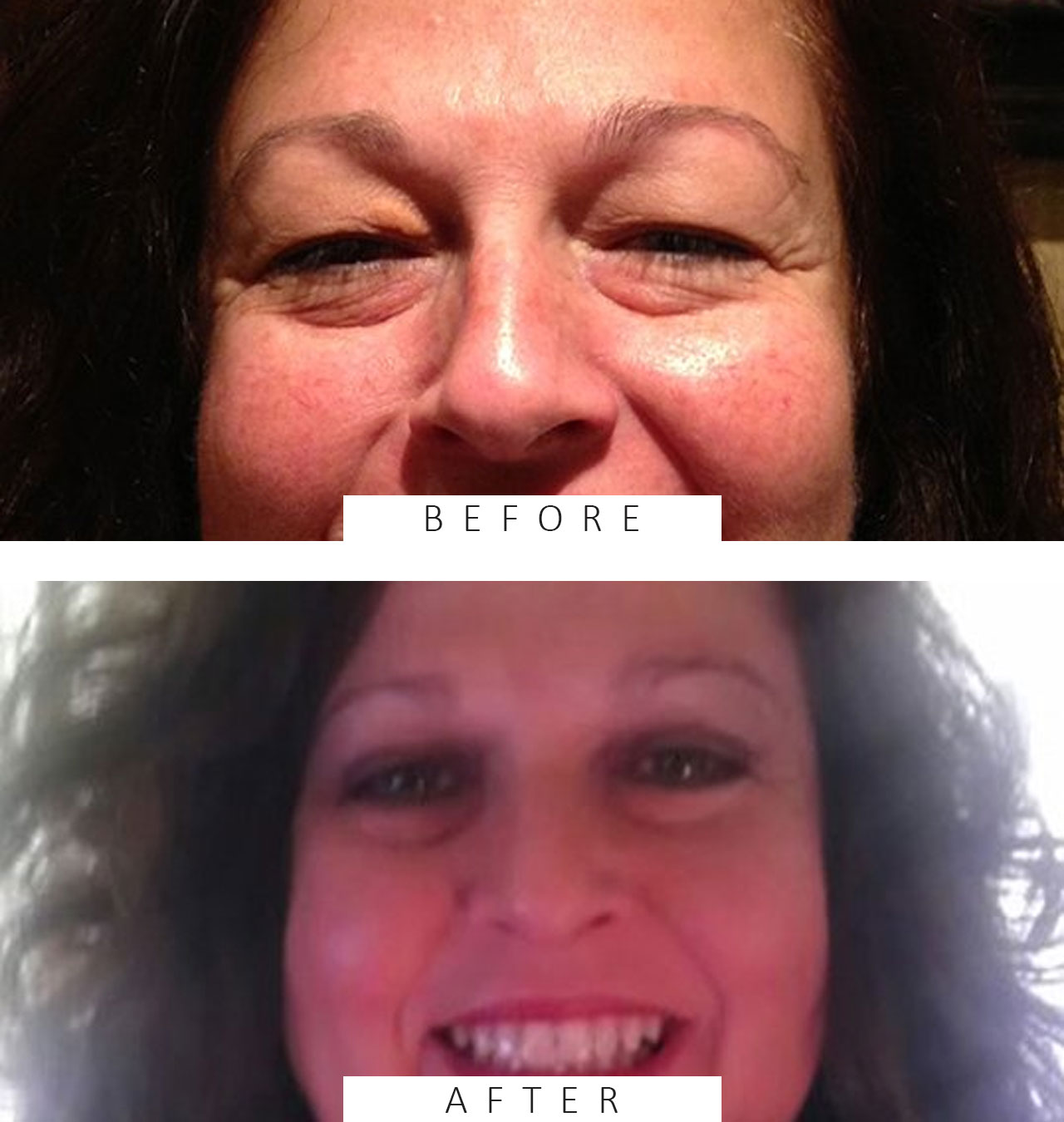 Upper Blepharoplasty to treat droopy eyelids to create a more youthful appearance.