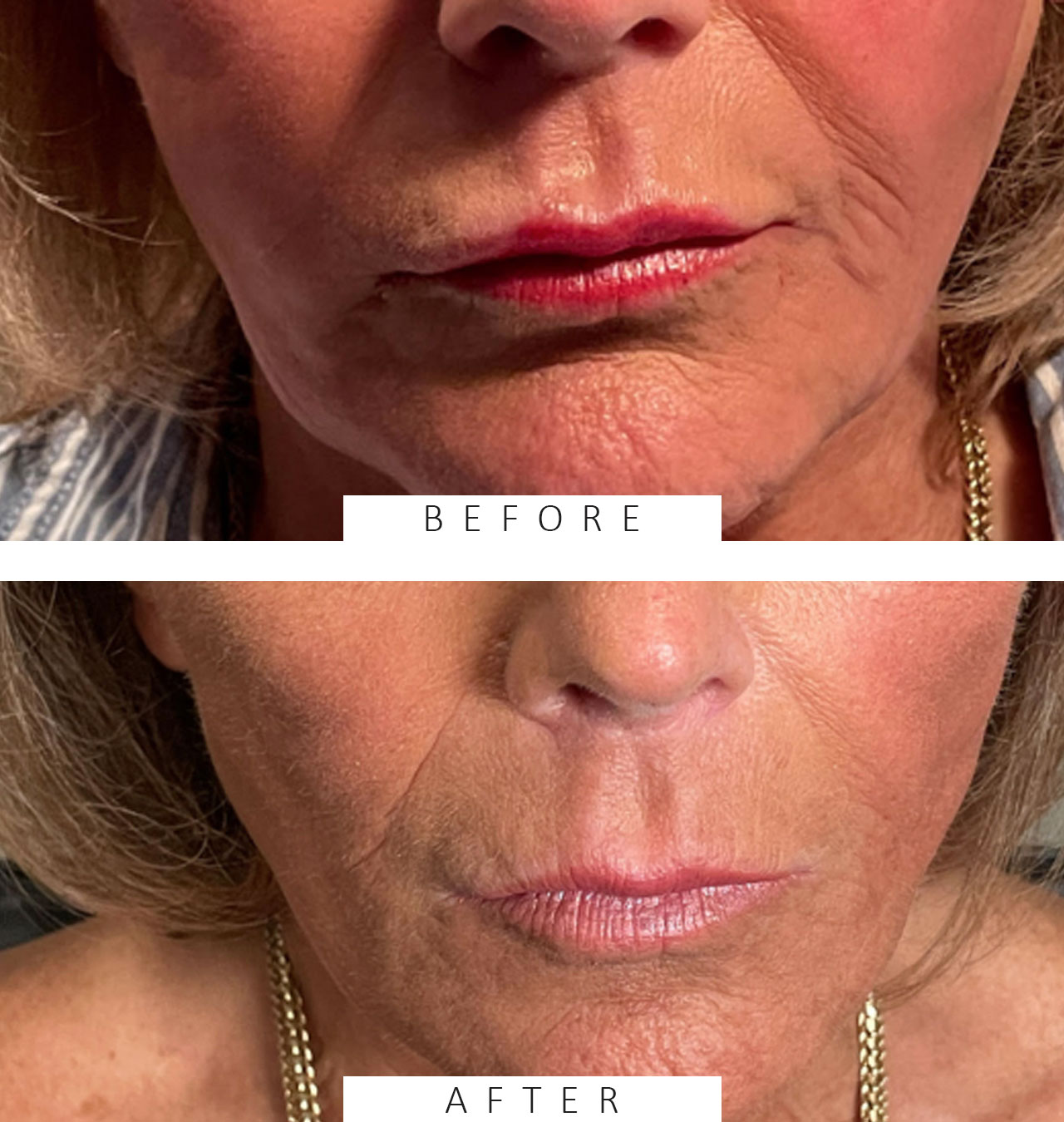 Lip fillers to straighten and symmetrize upper lips