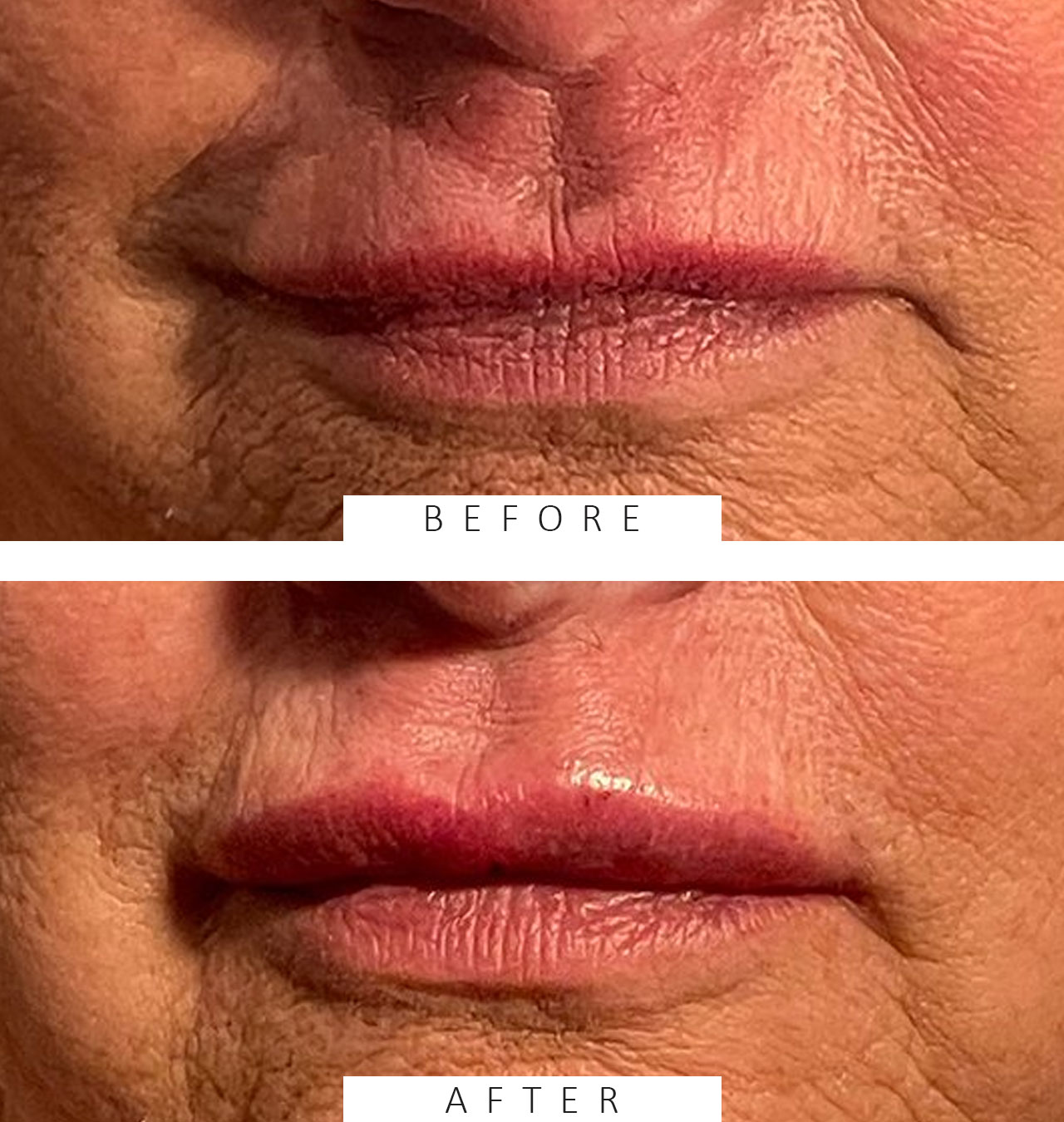 Lip filler with Restylane Silk