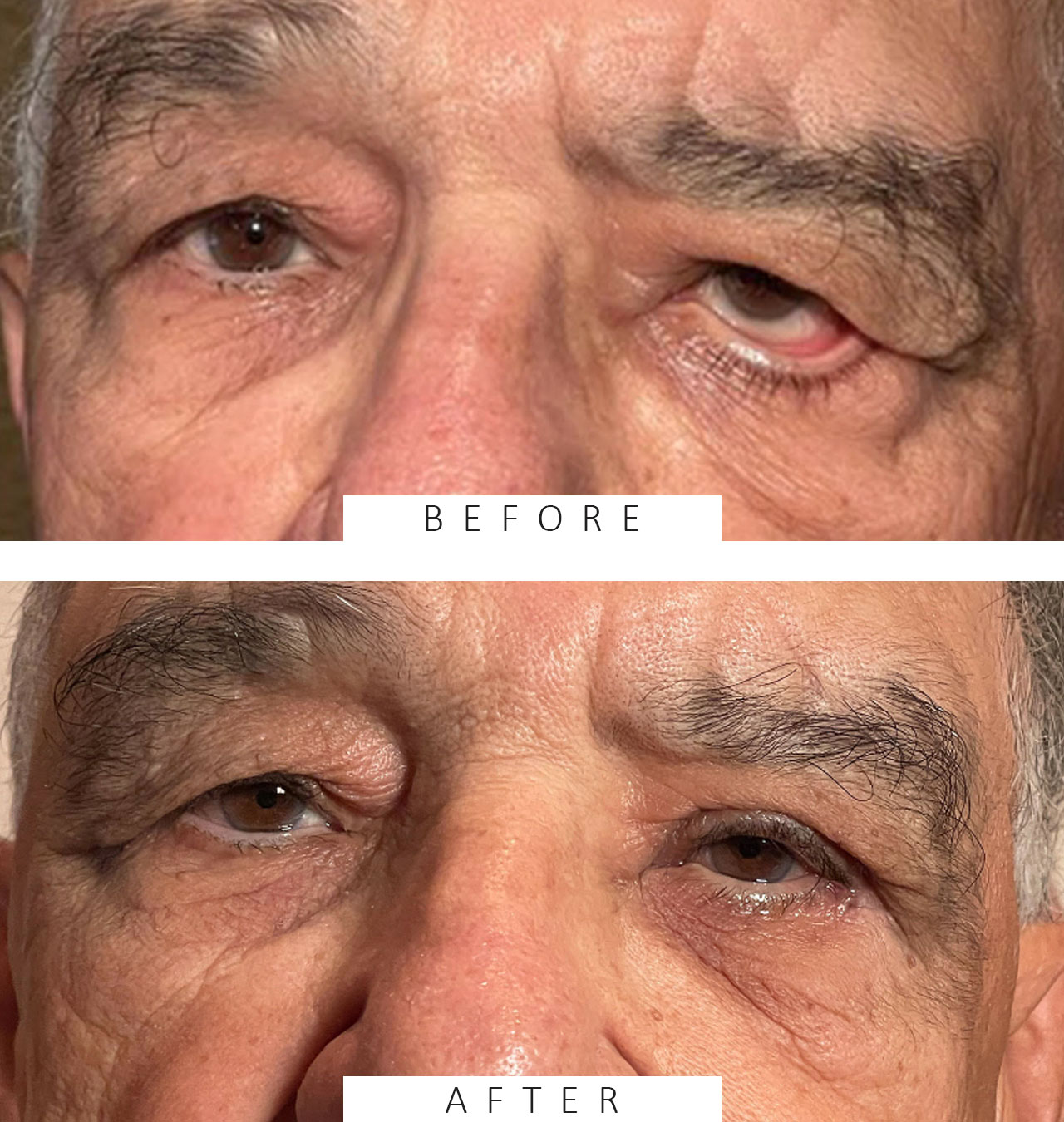 Repair of Paralysis of the Left Upper and Lower Lids & Brow Ptosis Following Severe Nerve Damage and Palsy