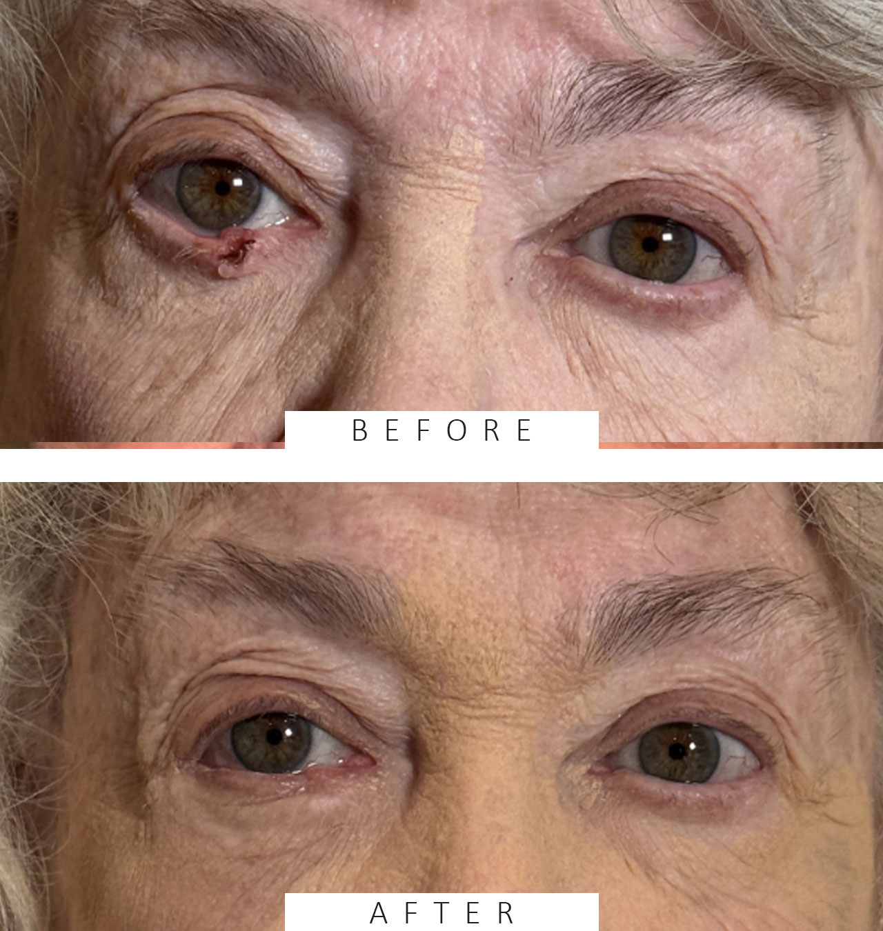 Basal Cell Carcinoma Right Lower lid Resection of tumor and Repair by Adjacent Tissue Transfer, Reconstruct Lower Lid and Lateral Canthus
