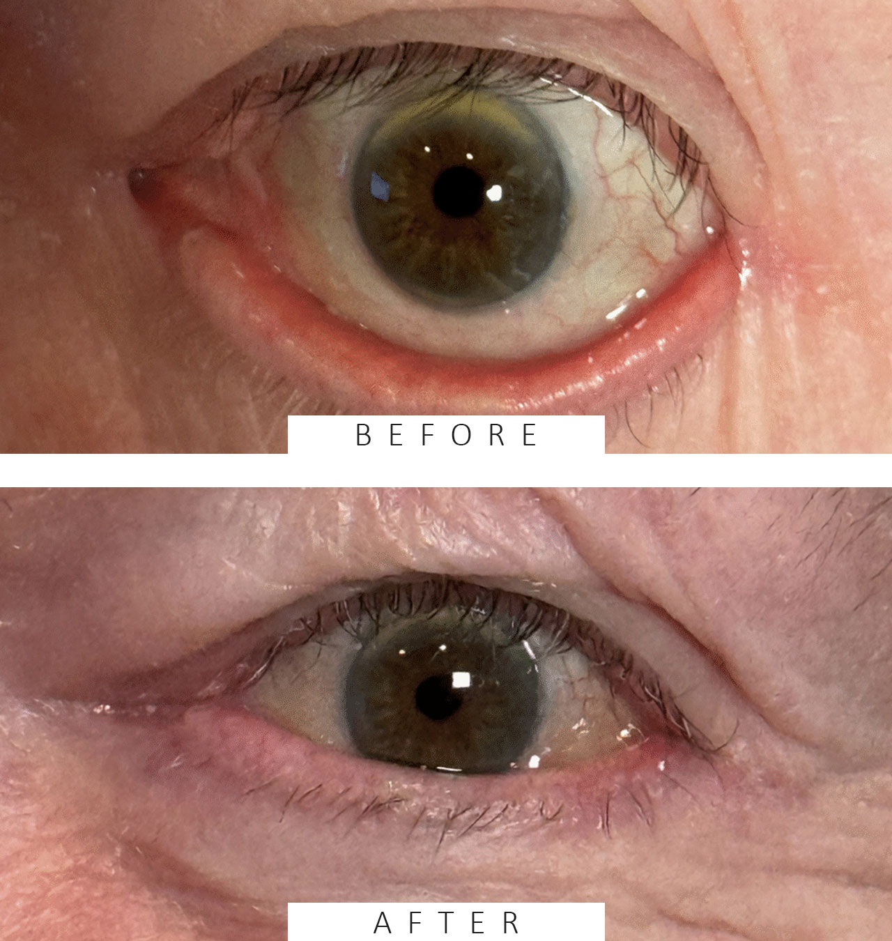 Repair Ectropion and Punctal Eversion
