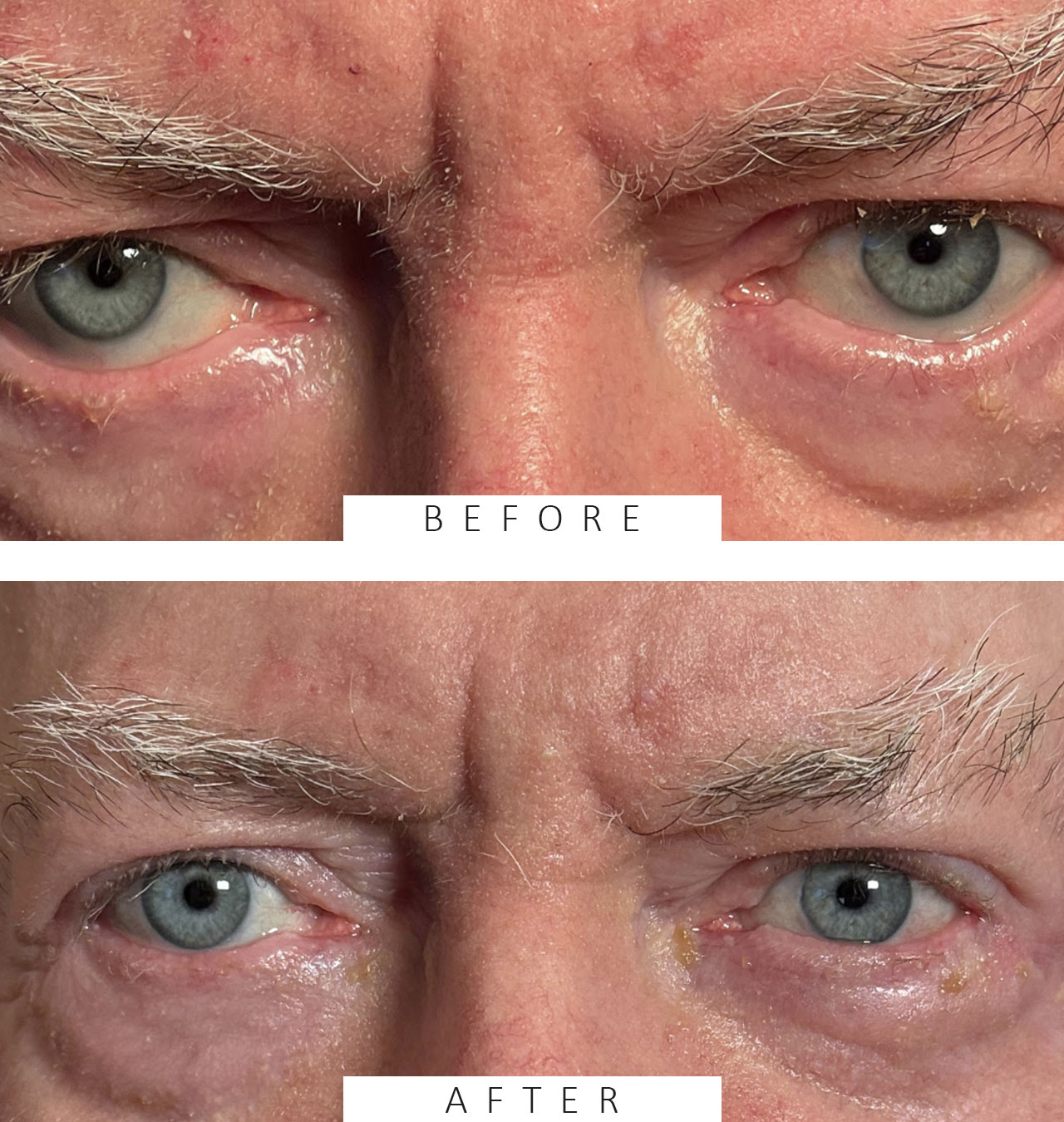 Ectropion Repair