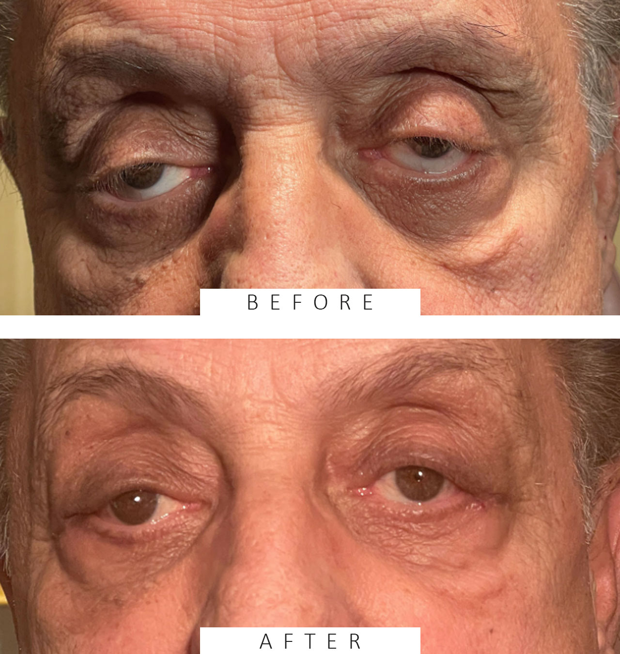 Ptosis Repair Both Upper Eyelids & Ectropion Repair Both Lower Lids