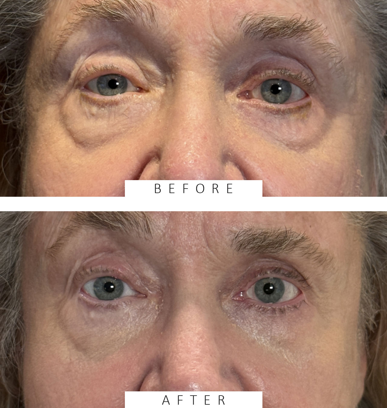 Laser Skin Resurfacing - CO2 laser Full Face