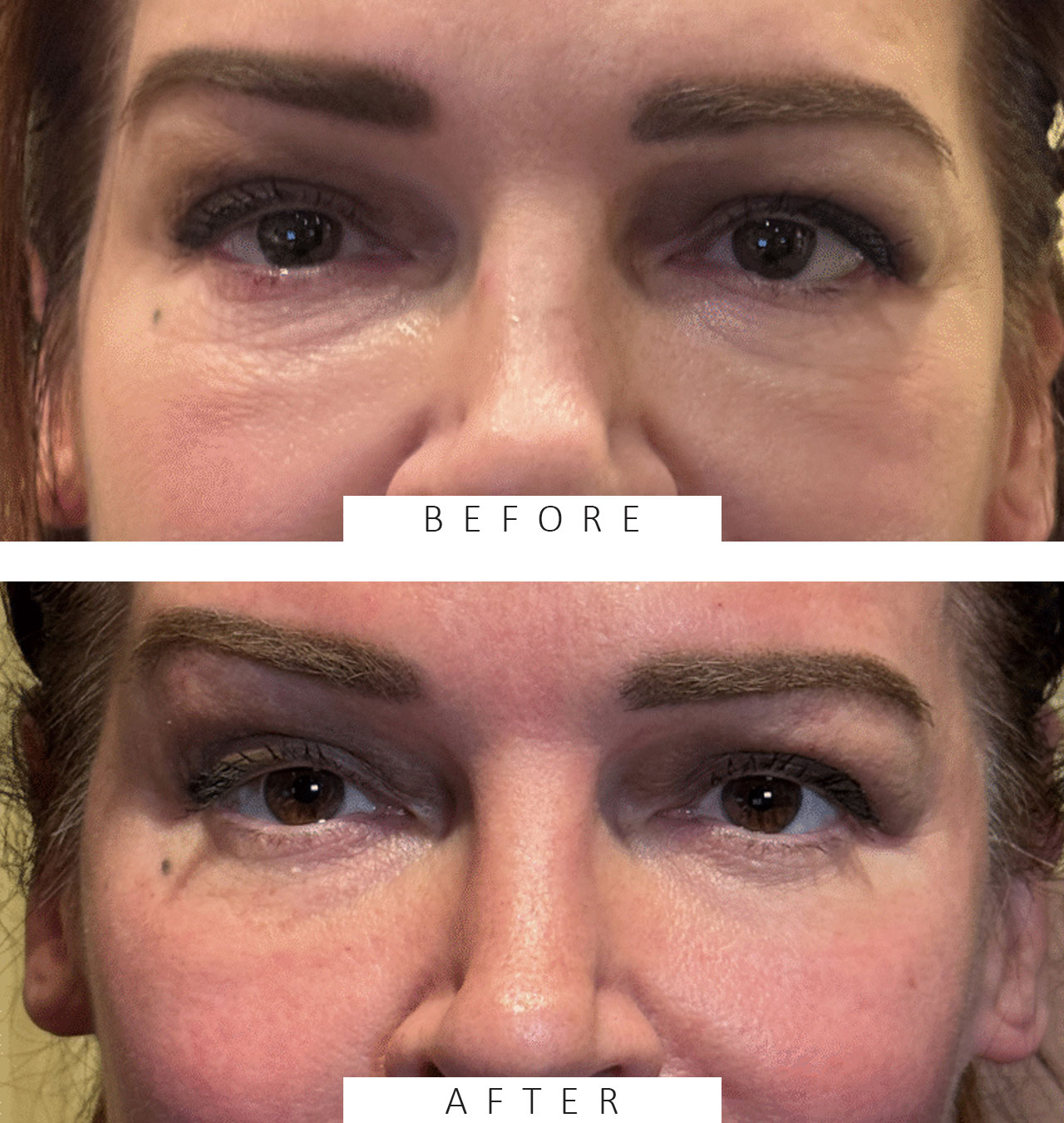 FULL FACE FRACTIONAL ABLATIVE CO2
