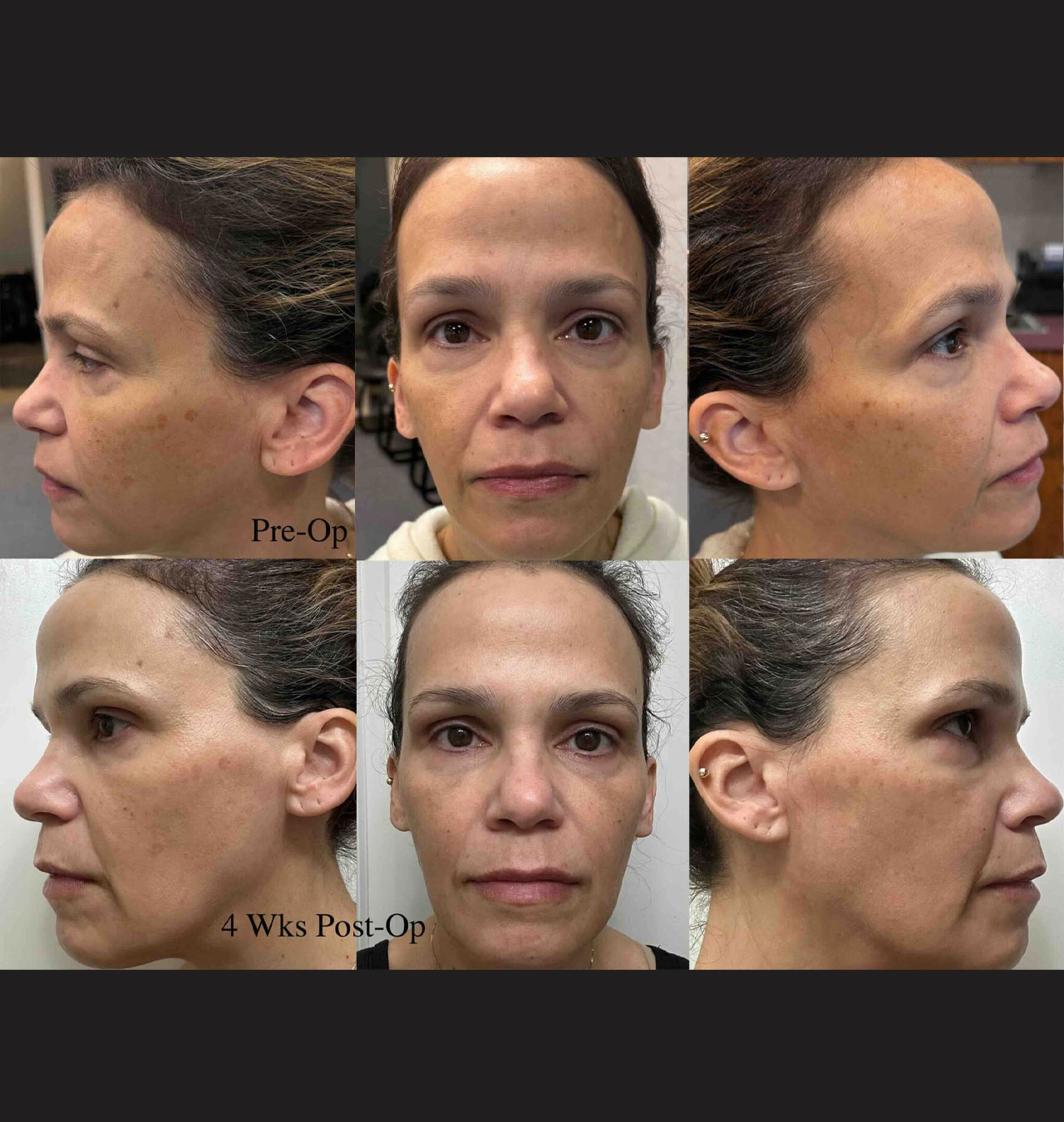Laser Skin Resurfacing - Fractional CO2 laser Full Face including Upper & Lower Eyelids