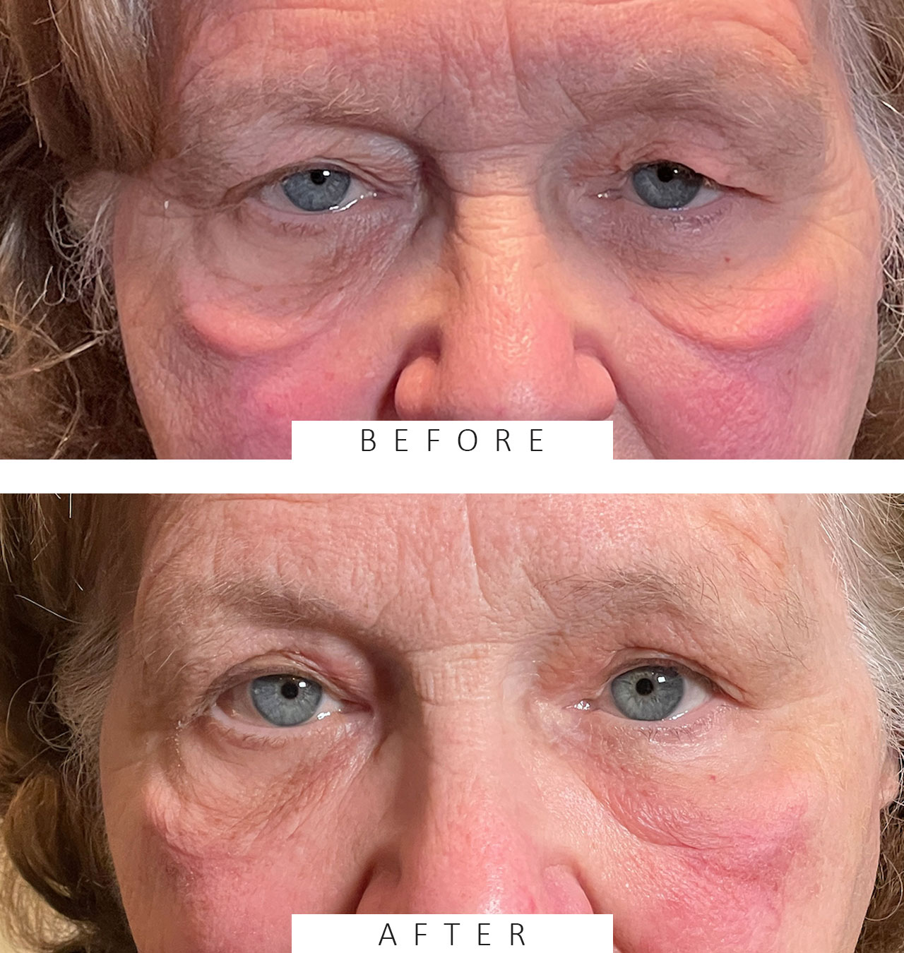 Upper Lid Ptosis Repair and Cosmetic Blepharoplasty