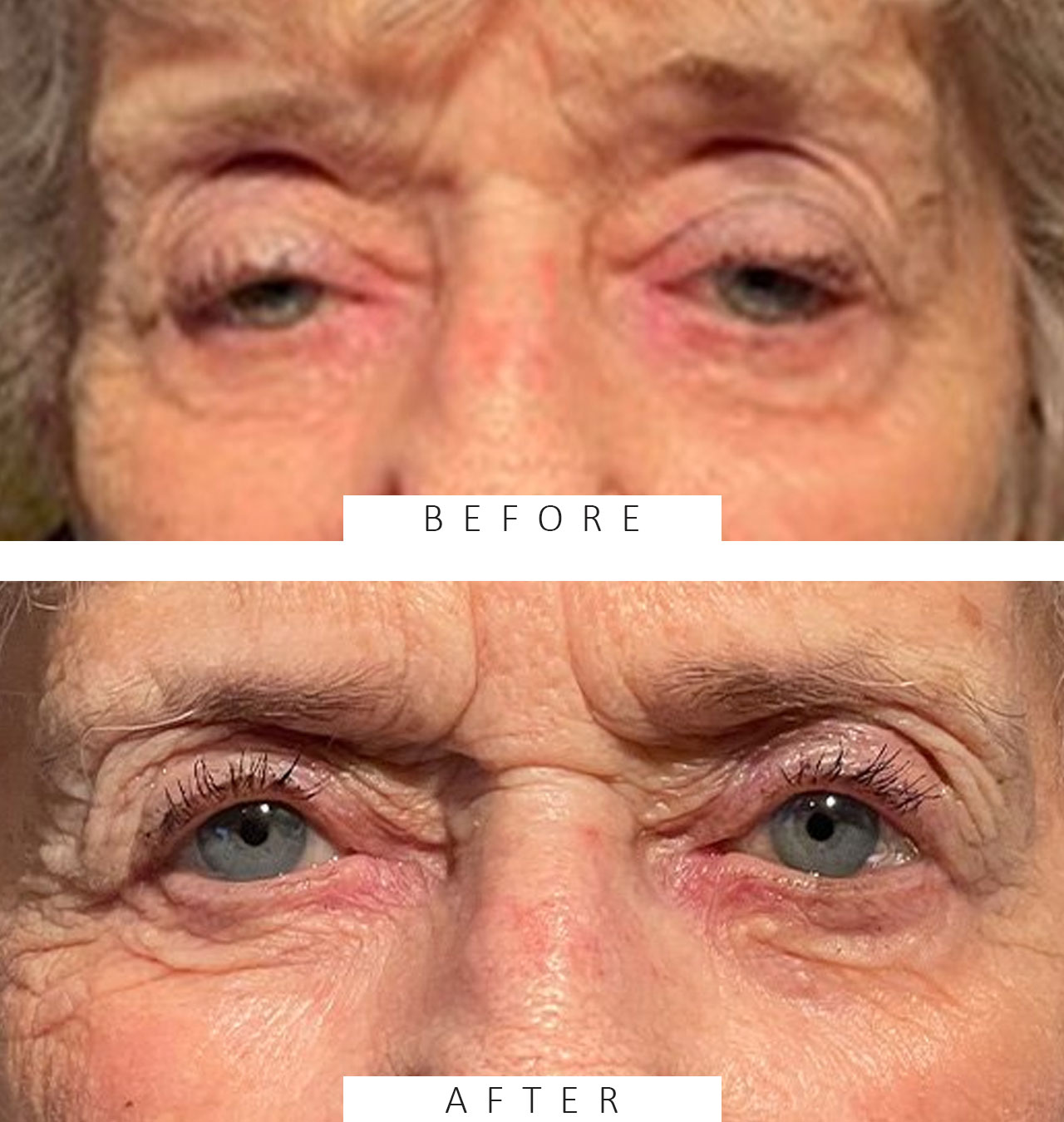 Ptosis Repair