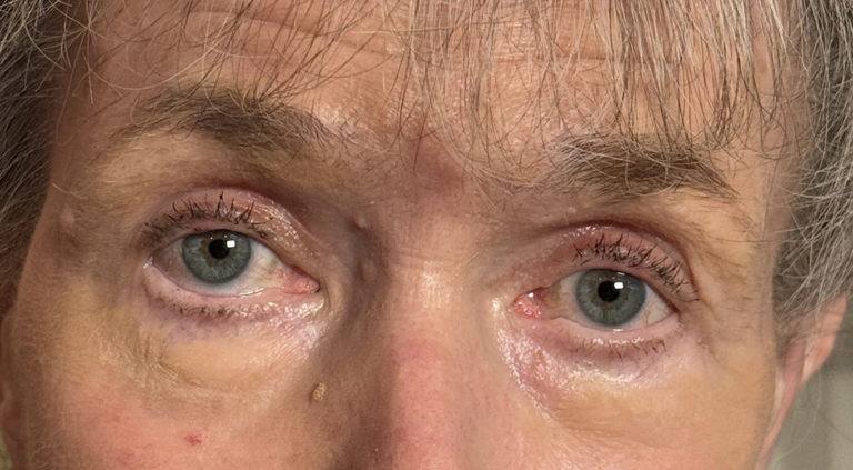 Cosmetic Blepharoplasty BULs After