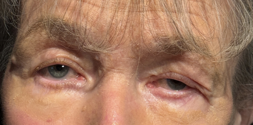 Cosmetic Blepharoplasty BULs Before