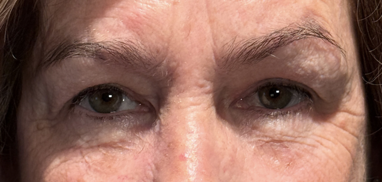 Cosmetic Blepharoplasty BULs After