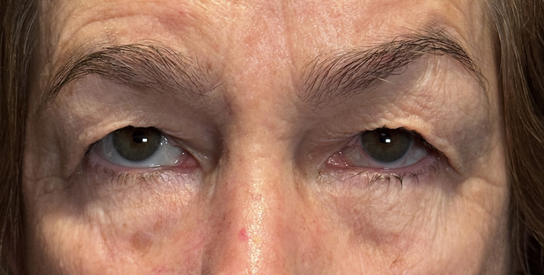 Cosmetic Blepharoplasty BULs Before