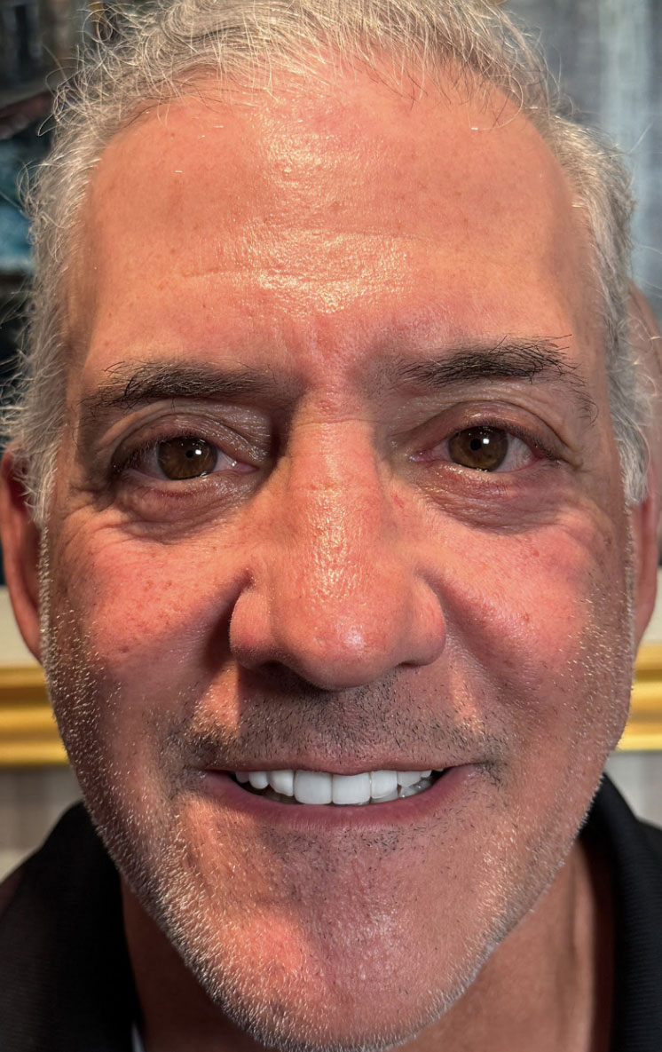 Ptosis Repair Both Upper Eyelids & Lower Eyelid Blepharoplasty with Fat Transposition After