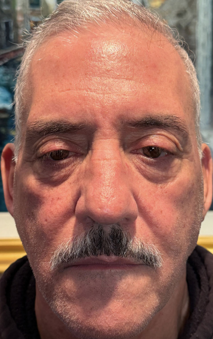 Ptosis Repair Both Upper Eyelids & Lower Eyelid Blepharoplasty with Fat Transposition Before