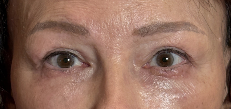 Blepharoplasty Both Upper and Both Lower Lids Full face Fractional CO2 Laser After
