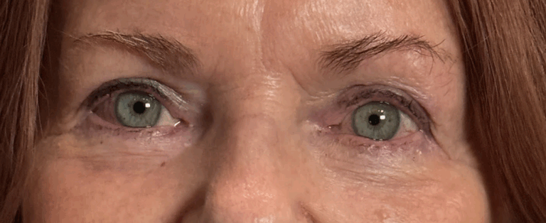 Upper and Lower Eyelid Blepharoplasty After