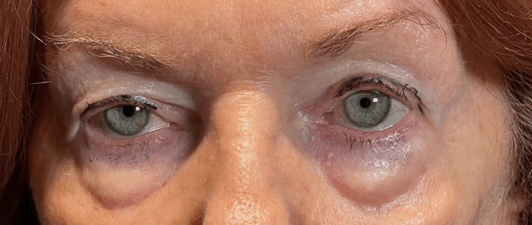 Upper and Lower Eyelid Blepharoplasty Before