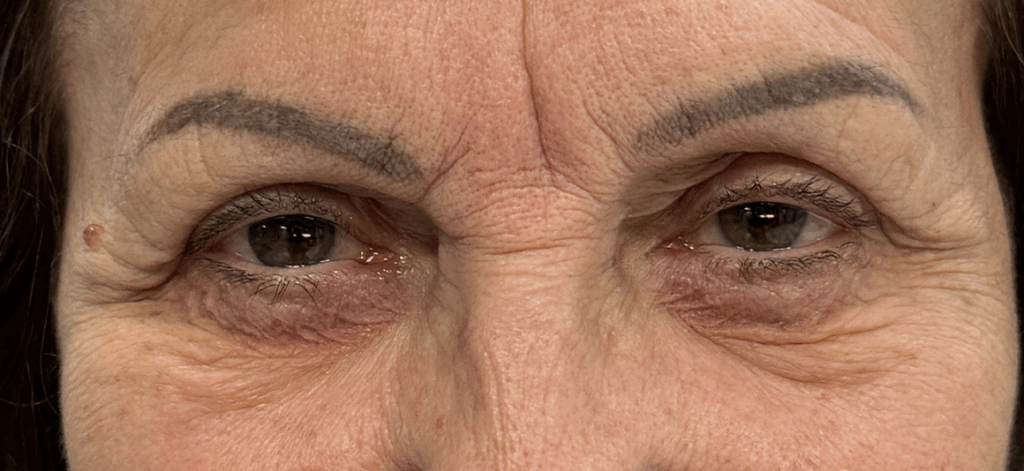 Upper and Lower Eyelid Blepharoplasty. Before