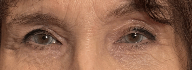 Lower Lid Blepharoplasty with Fat Transposition to Efface Hollows and Reduce Fat Bags After