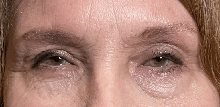 Lower Lid Blepharoplasty with Fat Transposition to Efface Hollows and Reduce Fat Bags Before