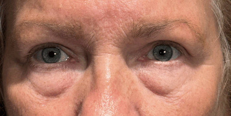 Cosmetic Blepharoplasty BULs & Ptosis Repair BULs After