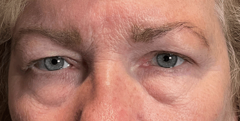 Cosmetic Blepharoplasty BULs & Ptosis Repair BULs Before