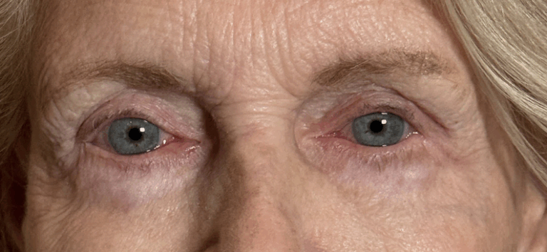 Upper Lid Blepharoplasty with Fat Transposition to mitigate Hollows/A-frame deformity Both Upper Lid Ptosis Repair MMCR Lower Lid Blepharoplasty with Skin Pinch Blepharoplasty Lateral Canthal Suspension After