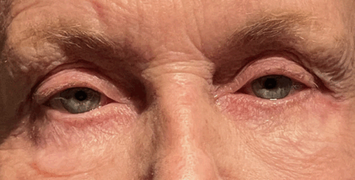 Upper Lid Blepharoplasty with Fat Transposition to mitigate Hollows/A-frame deformity Both Upper Lid Ptosis Repair MMCR Lower Lid Blepharoplasty with Skin Pinch Blepharoplasty Lateral Canthal Suspension Before