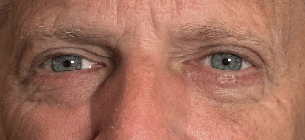 Cosmetic Blepharoplasty Both Upper and Lower Eyelids After