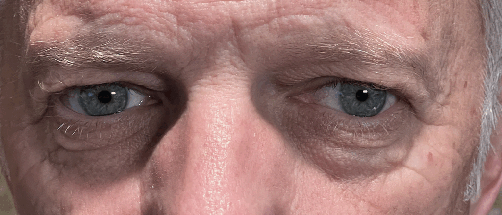 Cosmetic Blepharoplasty Both Upper and Lower Eyelids Before