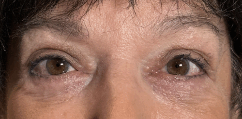Upper and Lower Lid Blepharoplasty Fat Transposition to Efface Lid/Cheek Hollows Skin Pinch to remove Excess Skin Lower lids. After