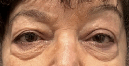 Upper and Lower Lid Blepharoplasty Fat Transposition to Efface Lid/Cheek Hollows Skin Pinch to remove Excess Skin Lower lids. Before