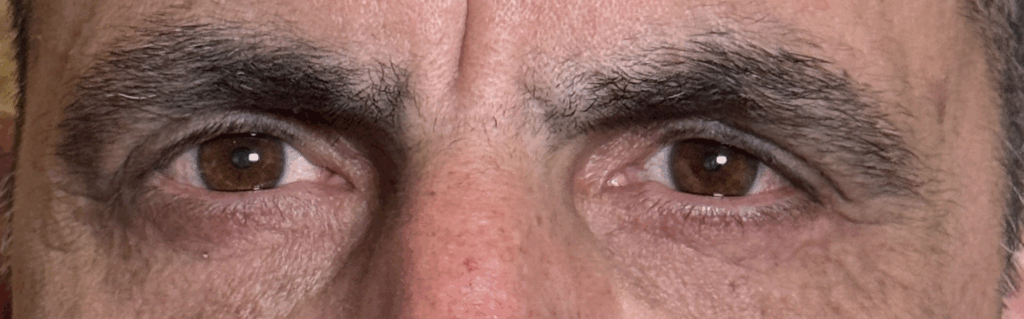 Blepharoplasty Both Upper and Lower Lids After