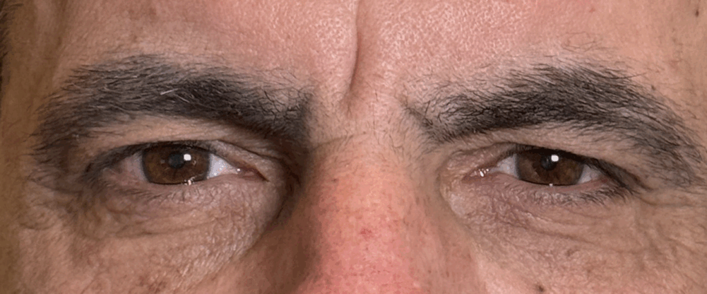 Blepharoplasty Both Upper and Lower Lids Before