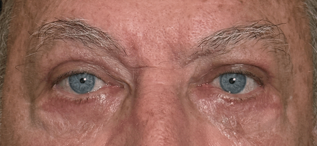 Upper and Lower Lid Cosmetic Blepharoplasty After